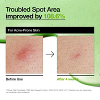 Thumbnail for Anua Azelaic Acid 10 Hyaluron Redness Soothing Serum, Facial Serum for Sensitive skin, Hyaluronic Acid, Niacinamide, Spot Care, Natural Color, Vegan, Korean Skincare (30ml/ 1.01 fl oz.)